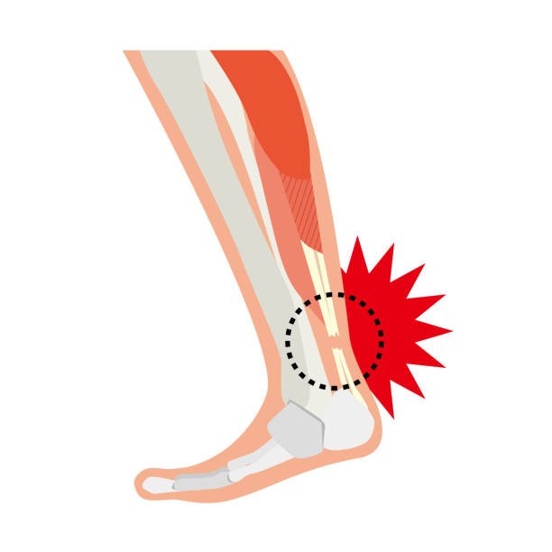 Achilles Tendon Injuries Treatment in Delhi